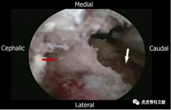 为什么会有单关节器械早读 ｜ 腰椎单边双通道内镜技术诞生的历史沿革_https://www.jmylbn.com_新闻资讯_第11张