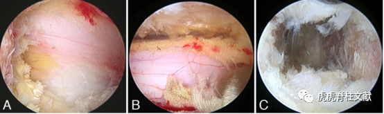 为什么会有单关节器械早读 ｜ 腰椎单边双通道内镜技术诞生的历史沿革_https://www.jmylbn.com_新闻资讯_第21张