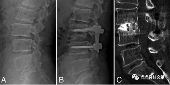 为什么会有单关节器械早读 ｜ 腰椎单边双通道内镜技术诞生的历史沿革_https://www.jmylbn.com_新闻资讯_第23张