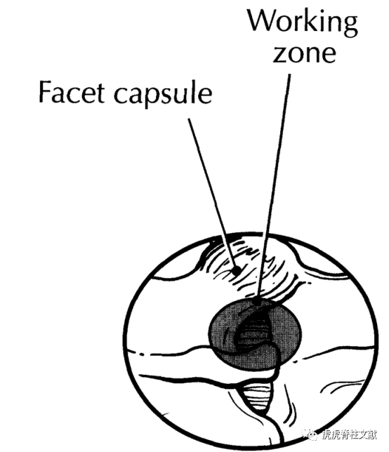 为什么会有单关节器械早读 ｜ 腰椎单边双通道内镜技术诞生的历史沿革_https://www.jmylbn.com_新闻资讯_第5张