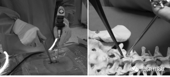 为什么会有单关节器械早读 ｜ 腰椎单边双通道内镜技术诞生的历史沿革_https://www.jmylbn.com_新闻资讯_第20张