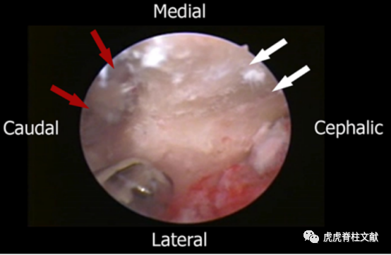 为什么会有单关节器械早读 ｜ 腰椎单边双通道内镜技术诞生的历史沿革_https://www.jmylbn.com_新闻资讯_第10张