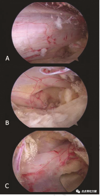 为什么会有单关节器械早读 ｜ 腰椎单边双通道内镜技术诞生的历史沿革_https://www.jmylbn.com_新闻资讯_第18张