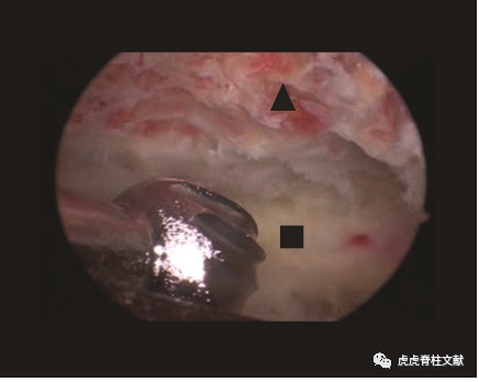 为什么会有单关节器械早读 ｜ 腰椎单边双通道内镜技术诞生的历史沿革_https://www.jmylbn.com_新闻资讯_第17张