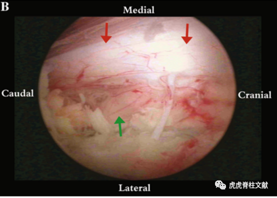 为什么会有单关节器械早读 ｜ 腰椎单边双通道内镜技术诞生的历史沿革_https://www.jmylbn.com_新闻资讯_第14张