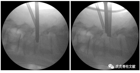 为什么会有单关节器械早读 ｜ 腰椎单边双通道内镜技术诞生的历史沿革_https://www.jmylbn.com_新闻资讯_第22张