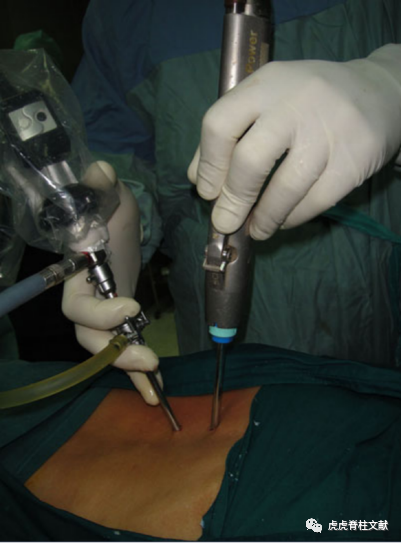 为什么会有单关节器械早读 ｜ 腰椎单边双通道内镜技术诞生的历史沿革_https://www.jmylbn.com_新闻资讯_第9张