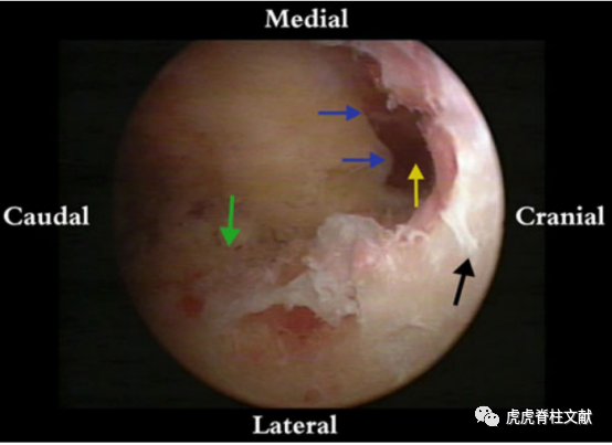 为什么会有单关节器械早读 ｜ 腰椎单边双通道内镜技术诞生的历史沿革_https://www.jmylbn.com_新闻资讯_第12张