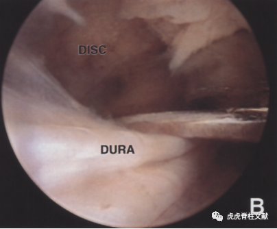 为什么会有单关节器械早读 ｜ 腰椎单边双通道内镜技术诞生的历史沿革_https://www.jmylbn.com_新闻资讯_第7张