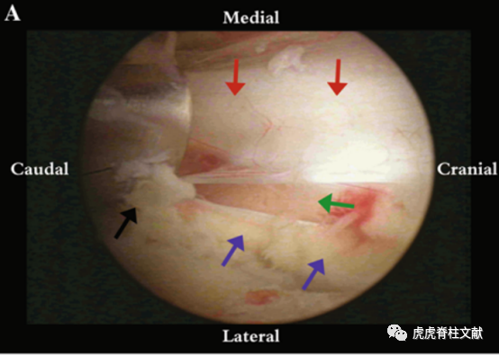 为什么会有单关节器械早读 ｜ 腰椎单边双通道内镜技术诞生的历史沿革_https://www.jmylbn.com_新闻资讯_第13张