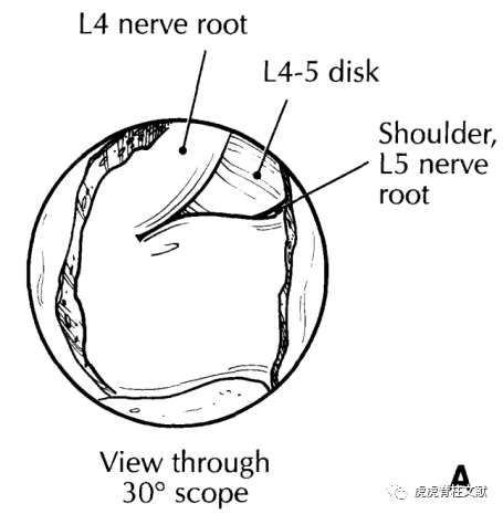 为什么会有单关节器械早读 ｜ 腰椎单边双通道内镜技术诞生的历史沿革_https://www.jmylbn.com_新闻资讯_第6张