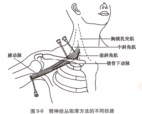 神经丛刺激针是什么O.A. (396)临床麻醉学，第九章（局部麻醉），第四节（常用的局部麻醉方法）_https://www.jmylbn.com_新闻资讯_第8张