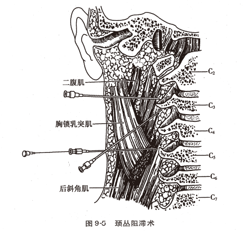 神经丛刺激针是什么O.A. (396)临床麻醉学，第九章（局部麻醉），第四节（常用的局部麻醉方法）_https://www.jmylbn.com_新闻资讯_第4张