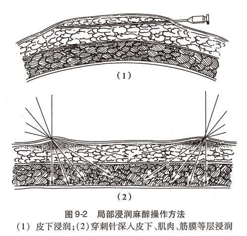 神经丛刺激针是什么O.A. (396)临床麻醉学，第九章（局部麻醉），第四节（常用的局部麻醉方法）_https://www.jmylbn.com_新闻资讯_第1张