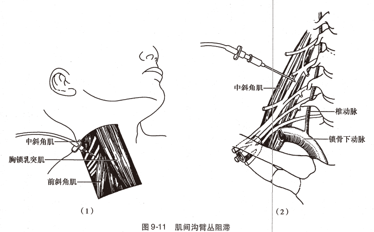 神经丛刺激针是什么O.A. (396)临床麻醉学，第九章（局部麻醉），第四节（常用的局部麻醉方法）_https://www.jmylbn.com_新闻资讯_第10张
