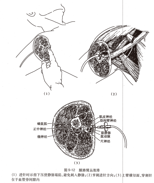 神经丛刺激针是什么O.A. (396)临床麻醉学，第九章（局部麻醉），第四节（常用的局部麻醉方法）_https://www.jmylbn.com_新闻资讯_第11张