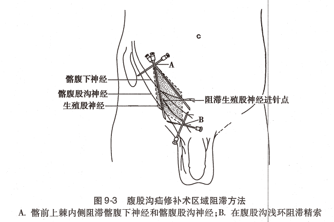 神经丛刺激针是什么O.A. (396)临床麻醉学，第九章（局部麻醉），第四节（常用的局部麻醉方法）_https://www.jmylbn.com_新闻资讯_第2张