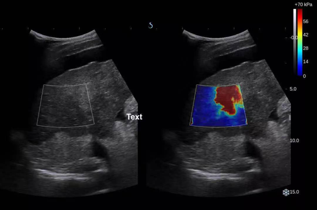 乳腺触诊成像怎么看我院跨入超声成像“E时代”——E超实现病灶的“声触诊”_https://www.jmylbn.com_新闻资讯_第6张