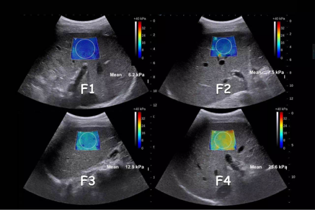 乳腺触诊成像怎么看我院跨入超声成像“E时代”——E超实现病灶的“声触诊”_https://www.jmylbn.com_新闻资讯_第5张
