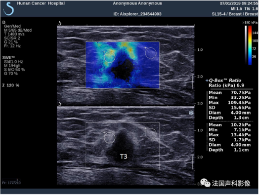 乳腺触诊成像怎么看我院跨入超声成像“E时代”——E超实现病灶的“声触诊”_https://www.jmylbn.com_新闻资讯_第8张