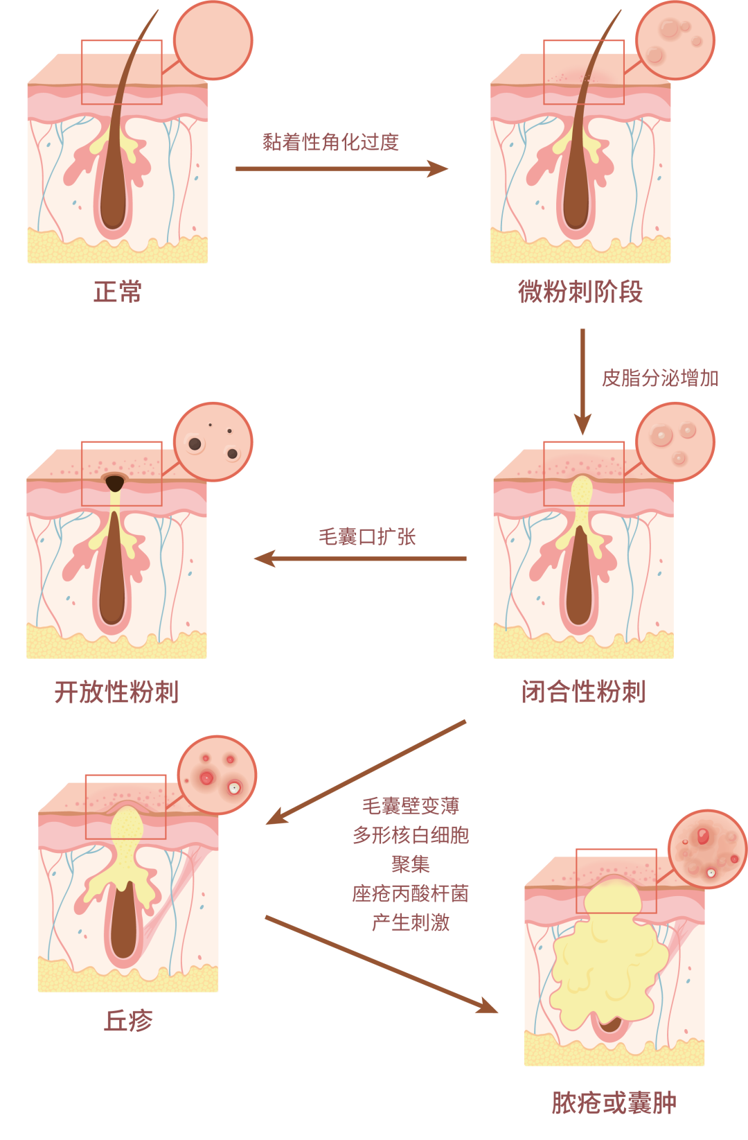 脸上长火疖子黑头闭口怎么办
