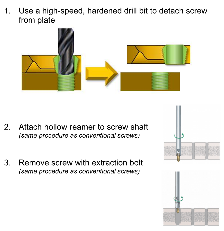 拆钉器怎么使用骨科速读 ｜ 内固定物取出手术相关知识点（下）_https://www.jmylbn.com_新闻资讯_第5张