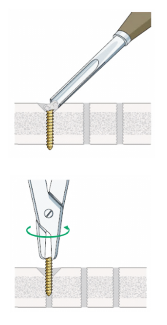 拆钉器怎么使用骨科速读 ｜ 内固定物取出手术相关知识点（下）_https://www.jmylbn.com_新闻资讯_第1张