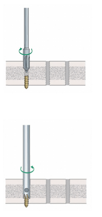 拆钉器怎么使用骨科速读 ｜ 内固定物取出手术相关知识点（下）_https://www.jmylbn.com_新闻资讯_第2张