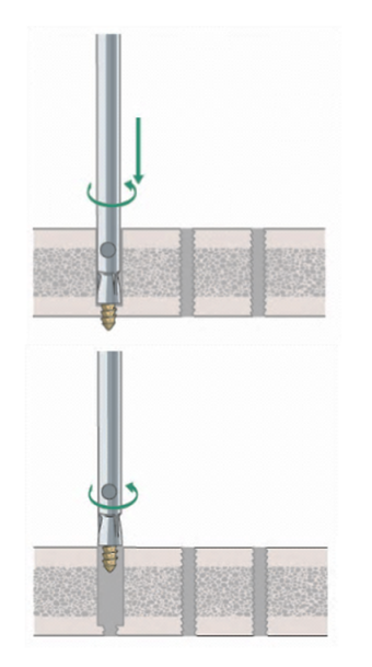 拆钉器怎么使用骨科速读 ｜ 内固定物取出手术相关知识点（下）_https://www.jmylbn.com_新闻资讯_第3张