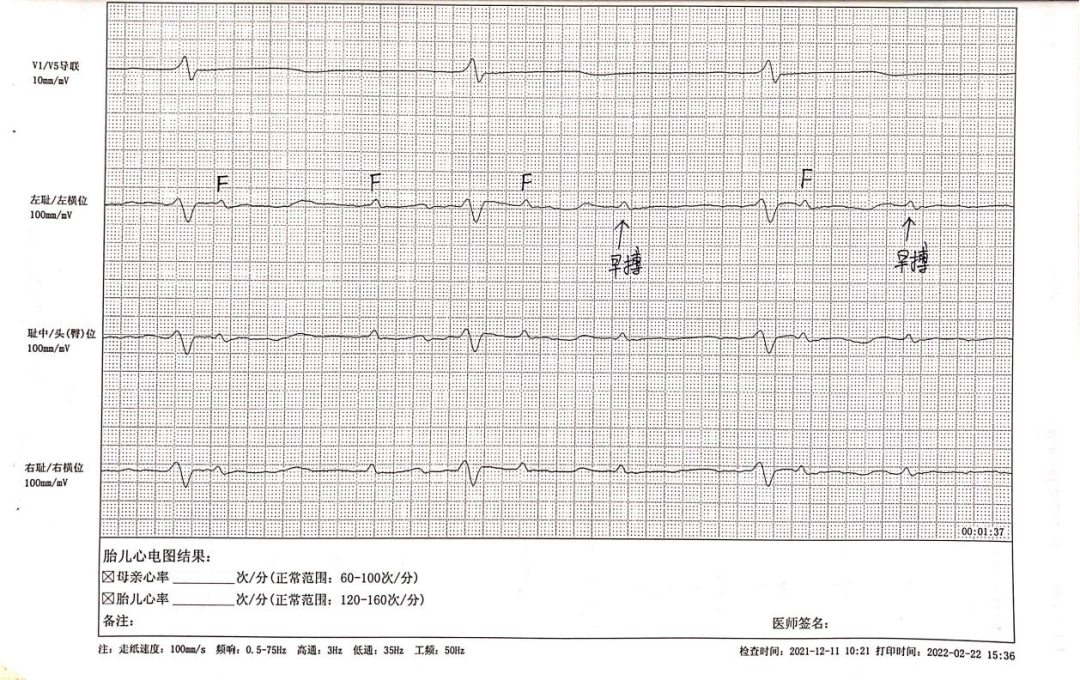 胎儿心电图是什么意思【科普文章】胎儿心电图的科普小知识_https://www.jmylbn.com_新闻资讯_第3张