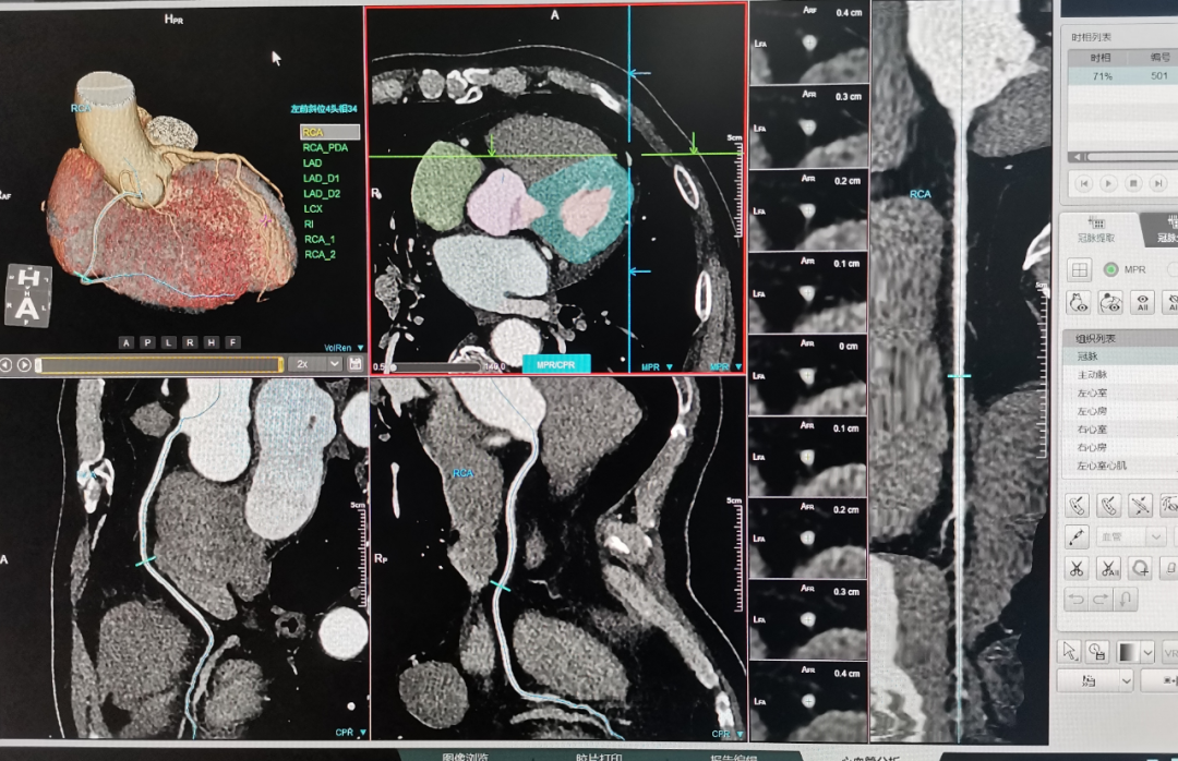 联影ct怎么样CT界的“神兵利器”--联影320排640层CT_https://www.jmylbn.com_新闻资讯_第7张