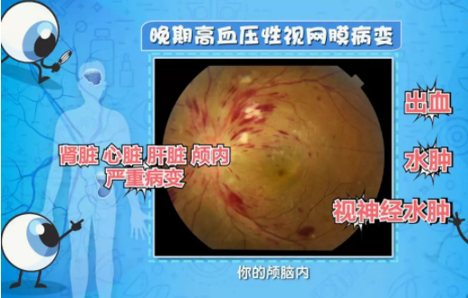 彩色眼底照相查什么拍一张眼底照片，就能帮你查清全身问题！_https://www.jmylbn.com_新闻资讯_第10张