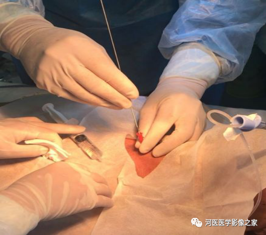 乳腺勾丝定位什么乳腺术前导丝定位你了解吗？-上海聚慕医疗器械有限公司
