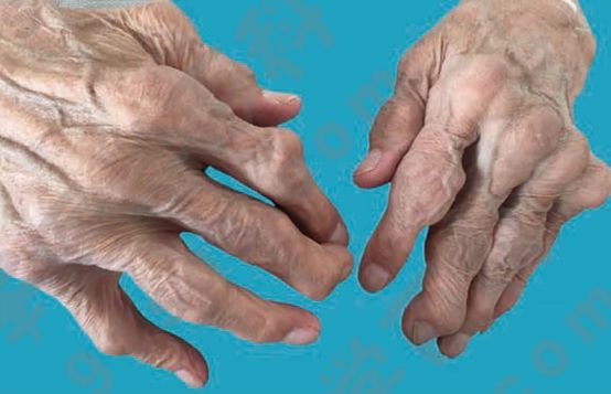 每4个类风湿关节炎患者就有1人出现这种问题