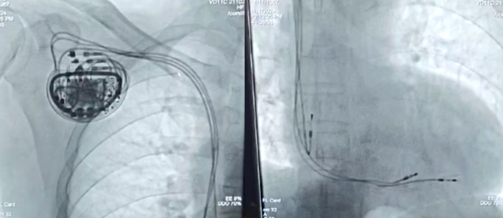 心脏治疗仪器是什么心衰器械治疗新突破——乐普医电创新产品心脏收缩力调节器（CCM）完成首例植入_https://www.jmylbn.com_新闻资讯_第2张