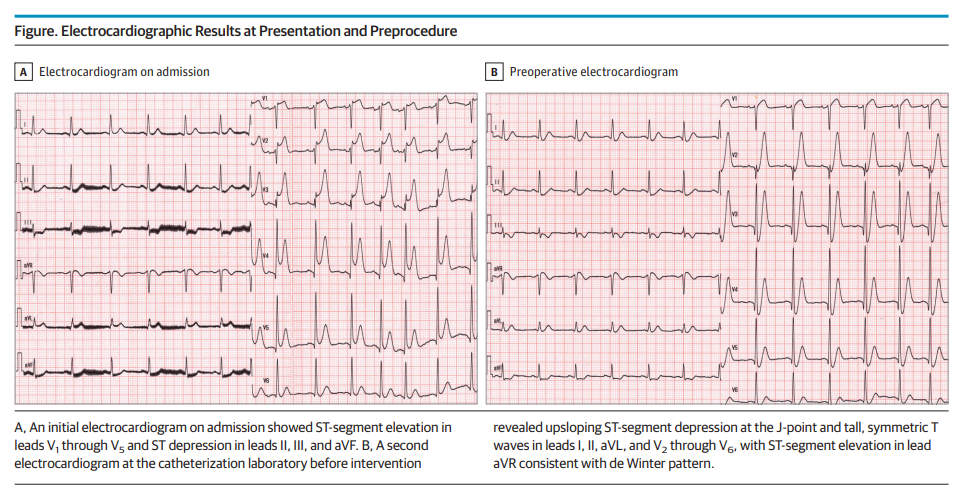 st模式是什么重磅｜郭金成教授团队于JAMA子刊发表一例由ST段抬高向de Winter模式动态演变的胸痛病例_https://www.jmylbn.com_新闻资讯_第3张