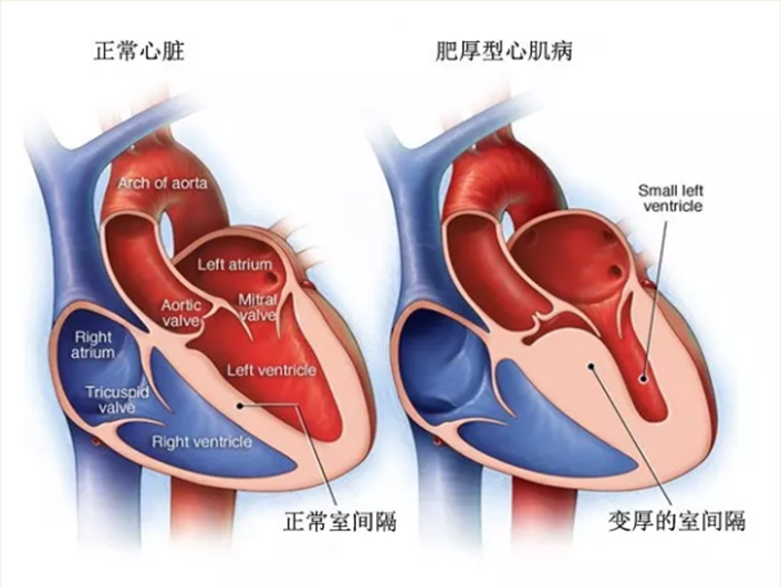 主要表现为左心室壁异常增厚,导致心脏舒张功能受损,从而影响泵血,易
