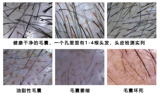 为什么先做毛囊检测？来看看你的脱发用不用治，能不能治