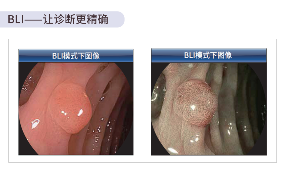 富士胃镜英文怎么写【新仪器新设备】“镜”观世界，健康“胃”来——富士VP-7000放大高清电子胃肠镜在我院投入使用_https://www.jmylbn.com_新闻资讯_第9张