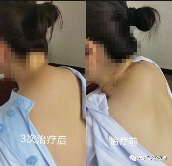 烫熨治疗贴怎么用【中医特色疗法】海南省人民医院定安分院推出这些中医特色疗法为健康护航！_https://www.jmylbn.com_新闻资讯_第3张