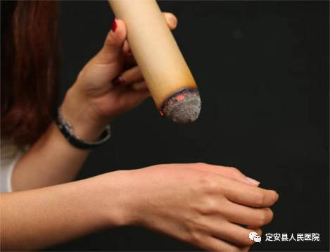 烫熨治疗贴怎么用【中医特色疗法】海南省人民医院定安分院推出这些中医特色疗法为健康护航！_https://www.jmylbn.com_新闻资讯_第17张
