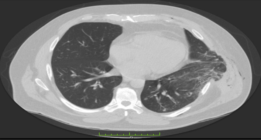 慢阻肺出现急性胸痛,看完胸部ct,我惊呆了!