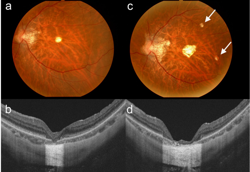 黄斑前膜术后为何视网膜脉络膜大面积萎缩有4点关键原因