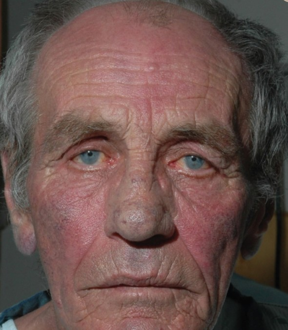 图文结合盘点7种皮肤潮红