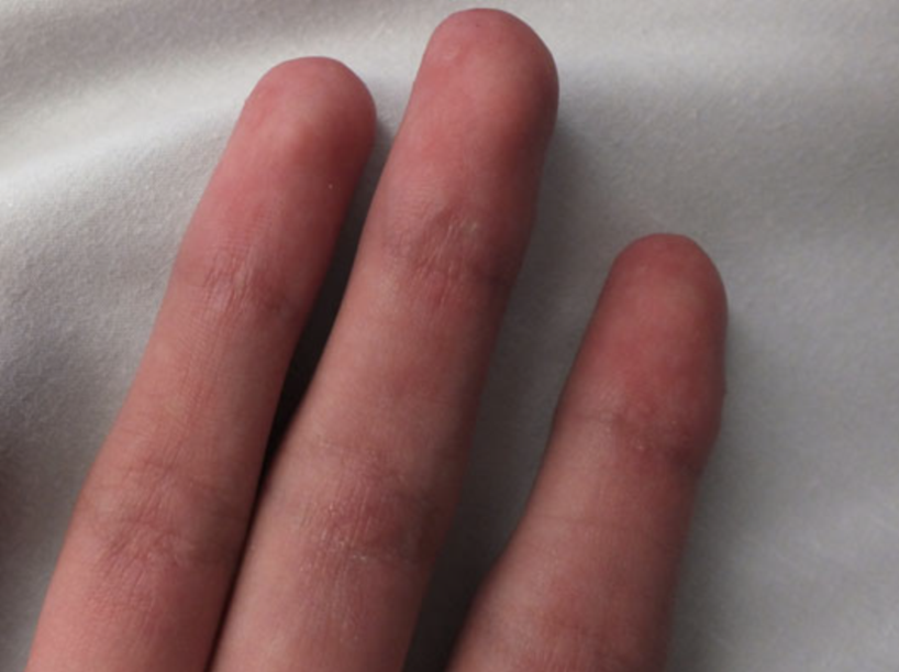 14岁女孩的指间角化性丘疹会是什么病看图诊断