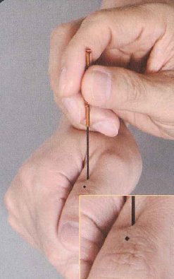 取穴贴于骨旁下针,针深二分至三分,一次两针齐下,谓之倒马针.