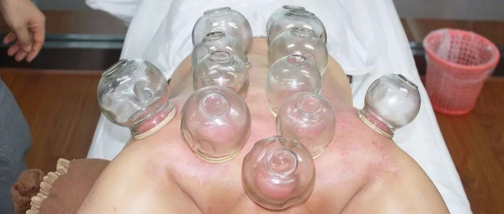 拔罐长水泡，是湿气重，还是技术差？关于拔罐的这些真相要知道！