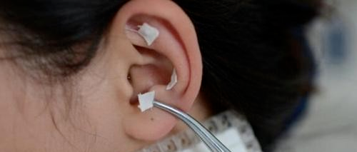 中医适宜技术——耳穴疗法