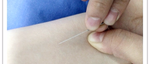 严重失眠、便秘，中医护理神器——腕踝针一招搞定！