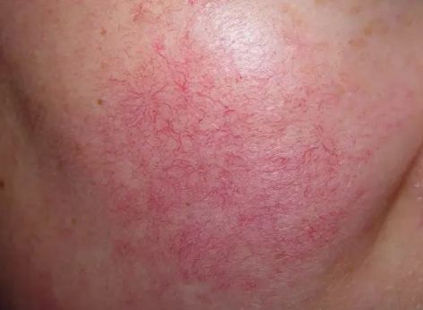 干货200多种皮肤病对照图(所有皮肤病图解大全图片大全）